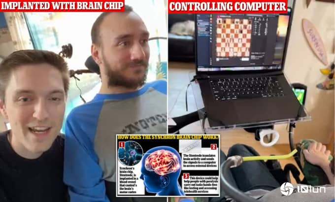 首位脑植Neuralink芯片康复者 示范用念力移动鼠标
